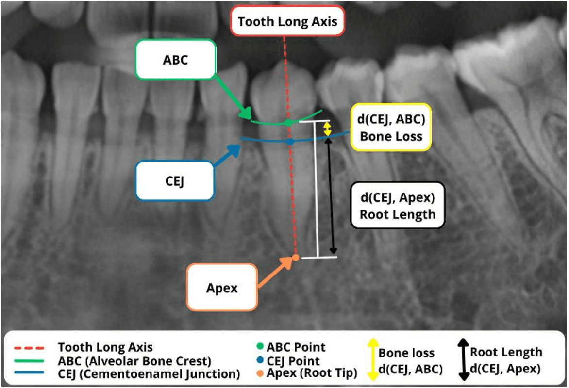 Illustration of bone loss severity classification